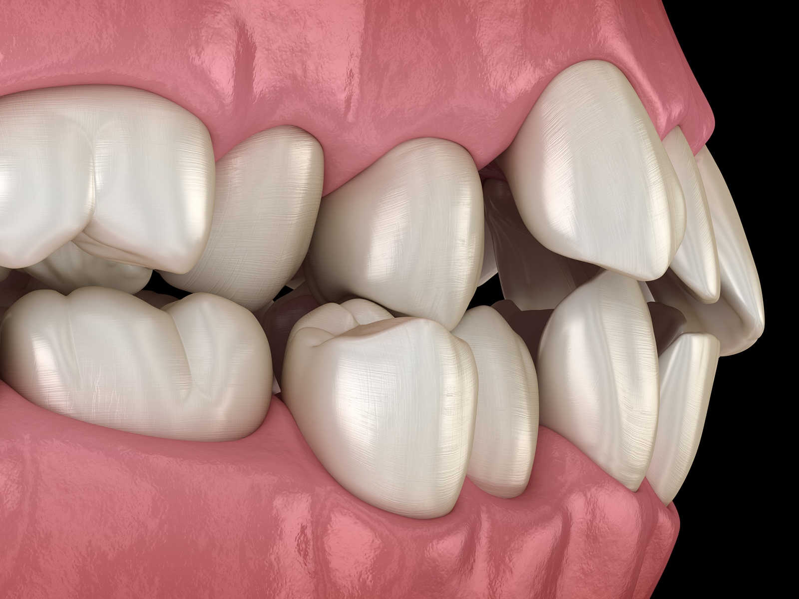 What Causes Protruding Teeth In Adults 