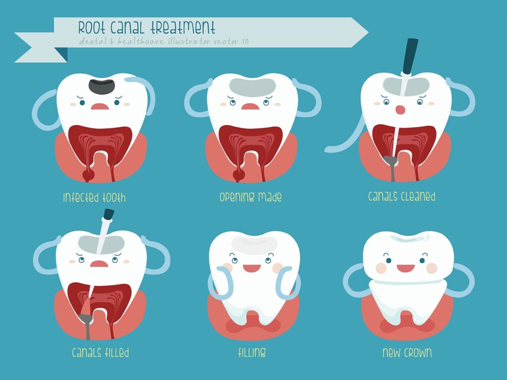 can-root-canals-fail