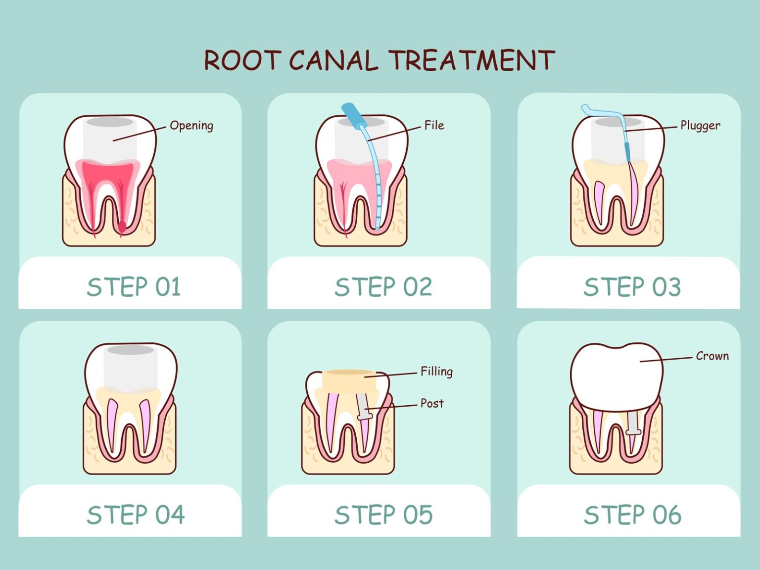 Does A Root Canal Bleed   Root Canal 1536x1152 