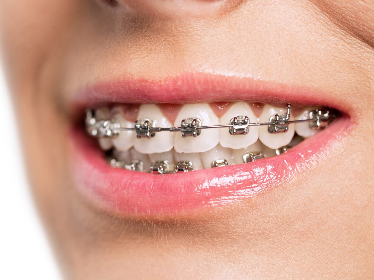 Can you stop wearing your retainer after 10 years? - Elgin