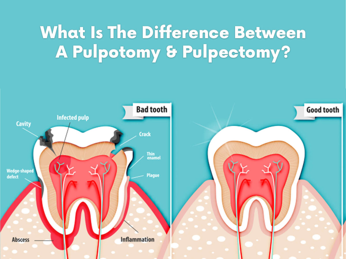 Difference Between A Pulpotomy & Pulpectomy