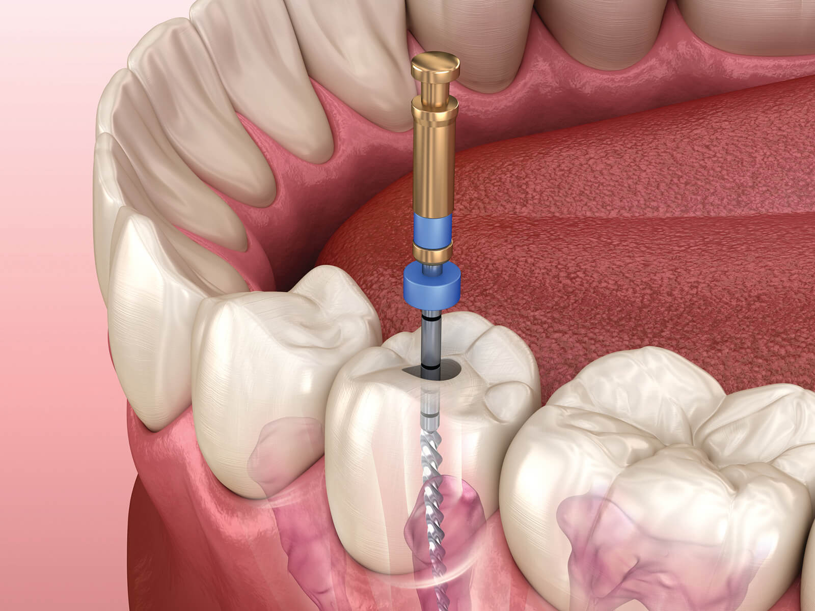 How To Prevent Another Root Canal Treatment