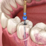 When Is Endodontic Retreatment Needed?