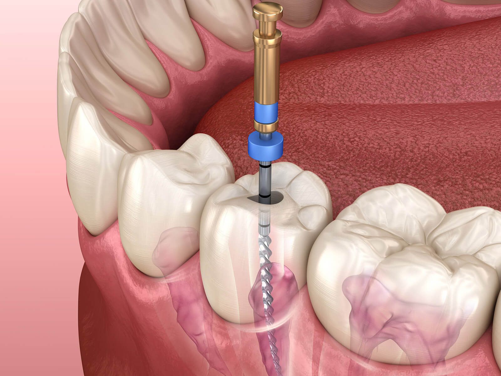 When Is Endodontic Retreatment Needed?