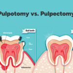 Pulpotomy vs. Pulpectomy: Understanding The Difference In Dental Treatments