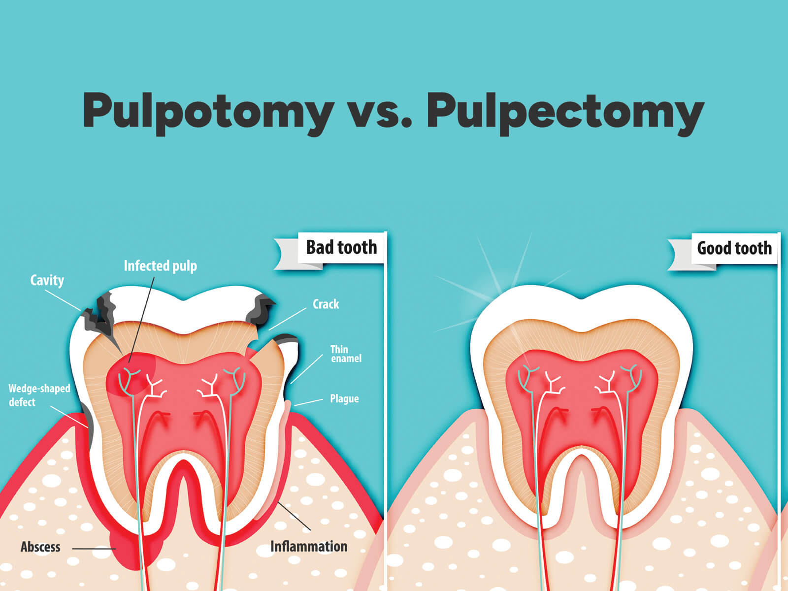 Pulpotomy vs. Pulpectomy: Understanding The Difference In Dental Treatments