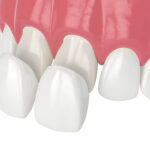 How Are Dental Veneers Used In A Smile Makeover?