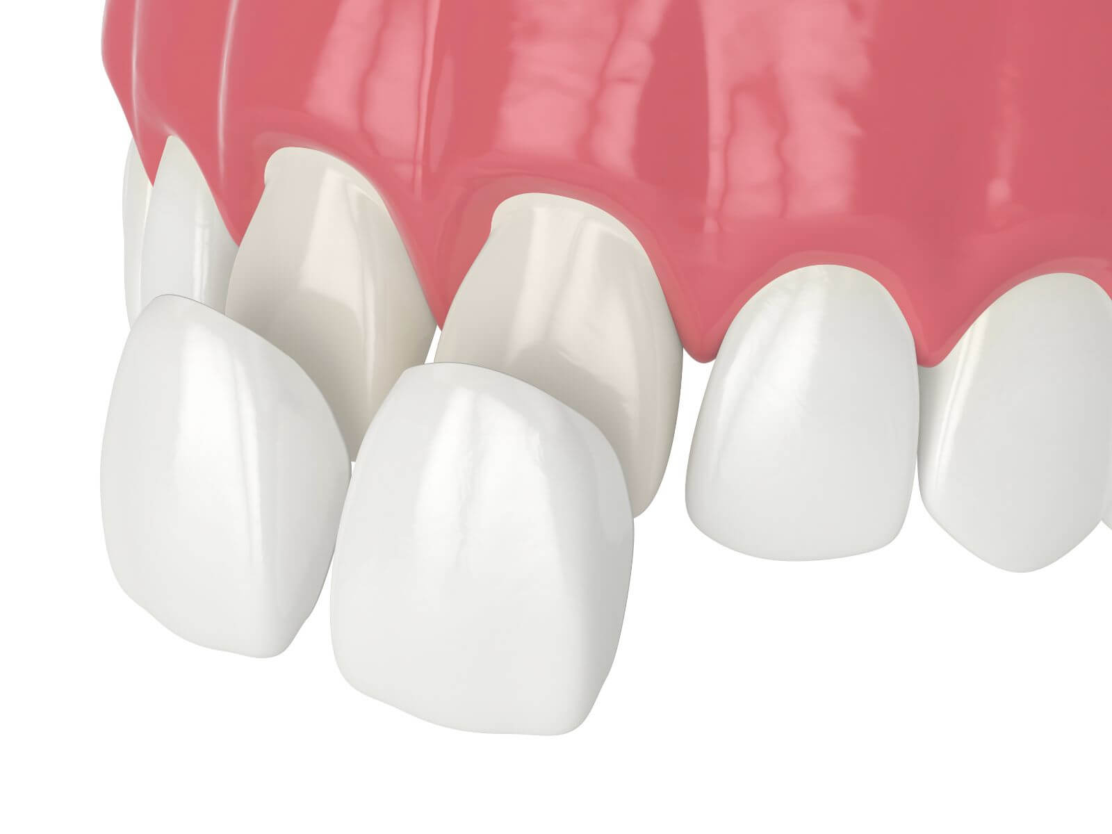 How Are Dental Veneers Used In A Smile Makeover?