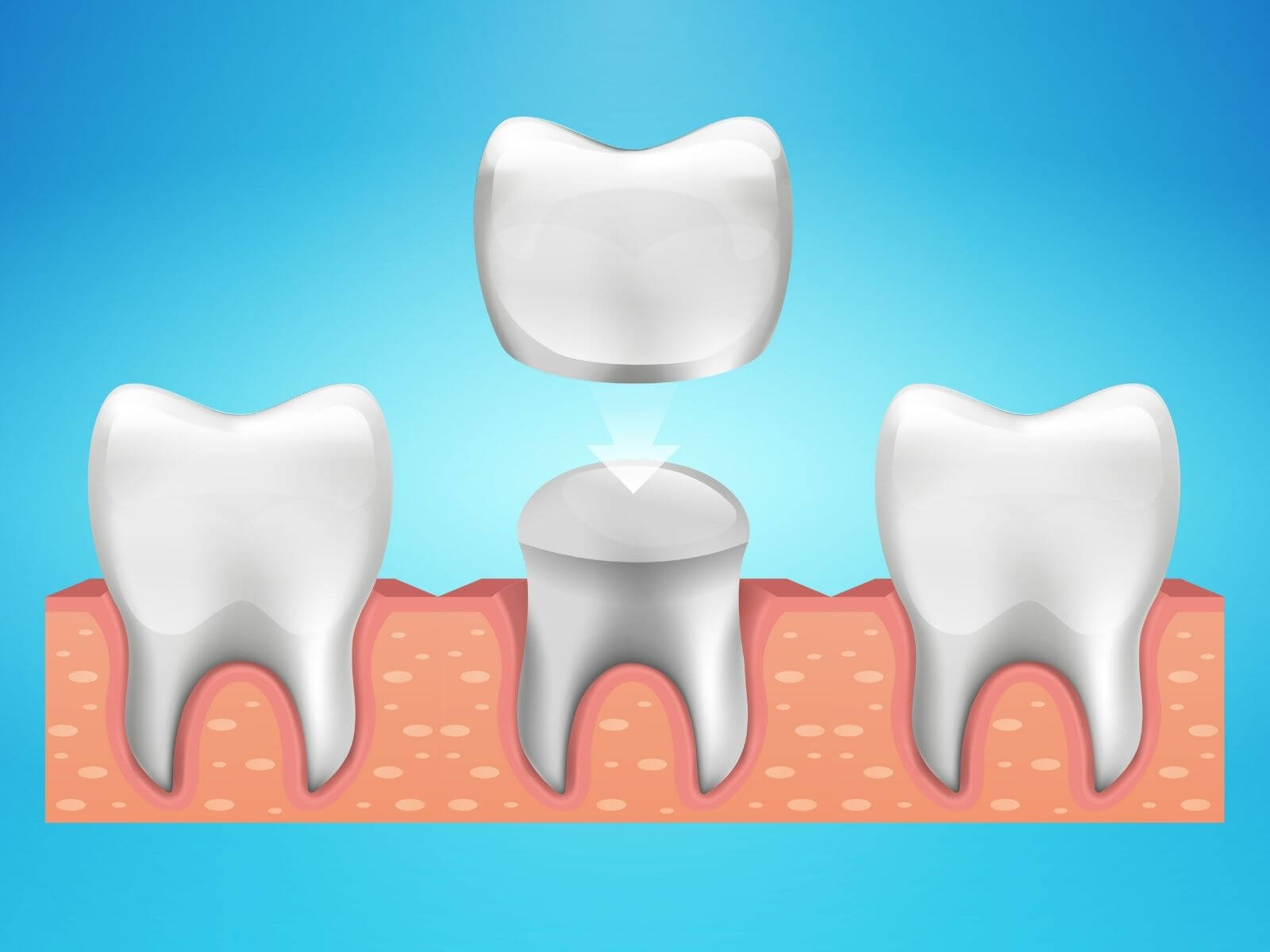 Dos And Don’ts After Getting A Dental Crown: A Complete Guide