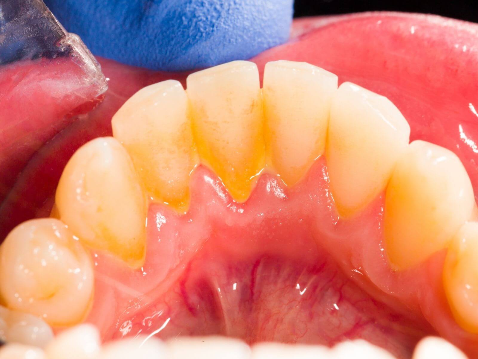 How Bacterial Plaque Causes Gum Disease And Tooth Decay