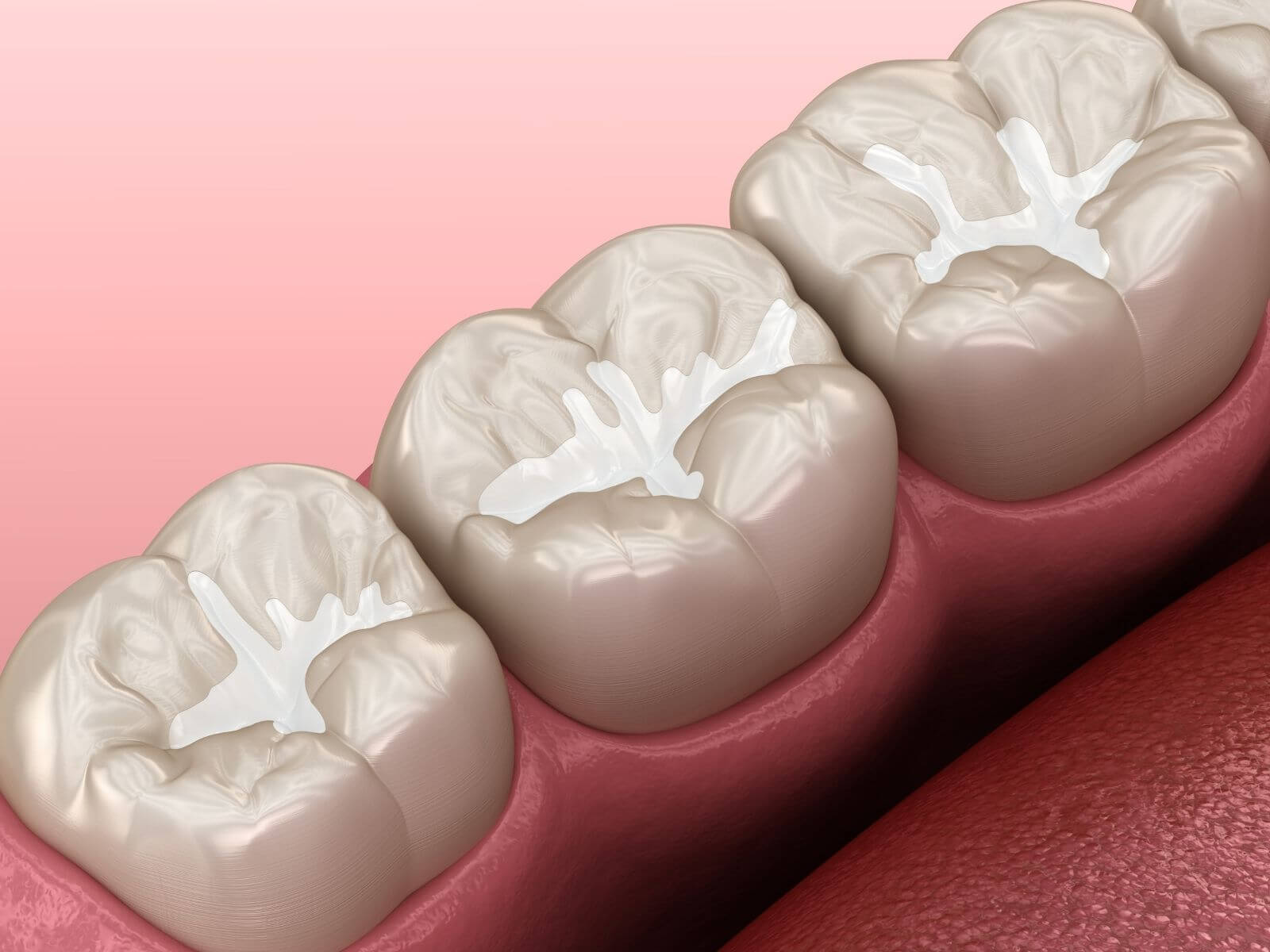 How Dental Sealants Protect Your Teeth From Cavities